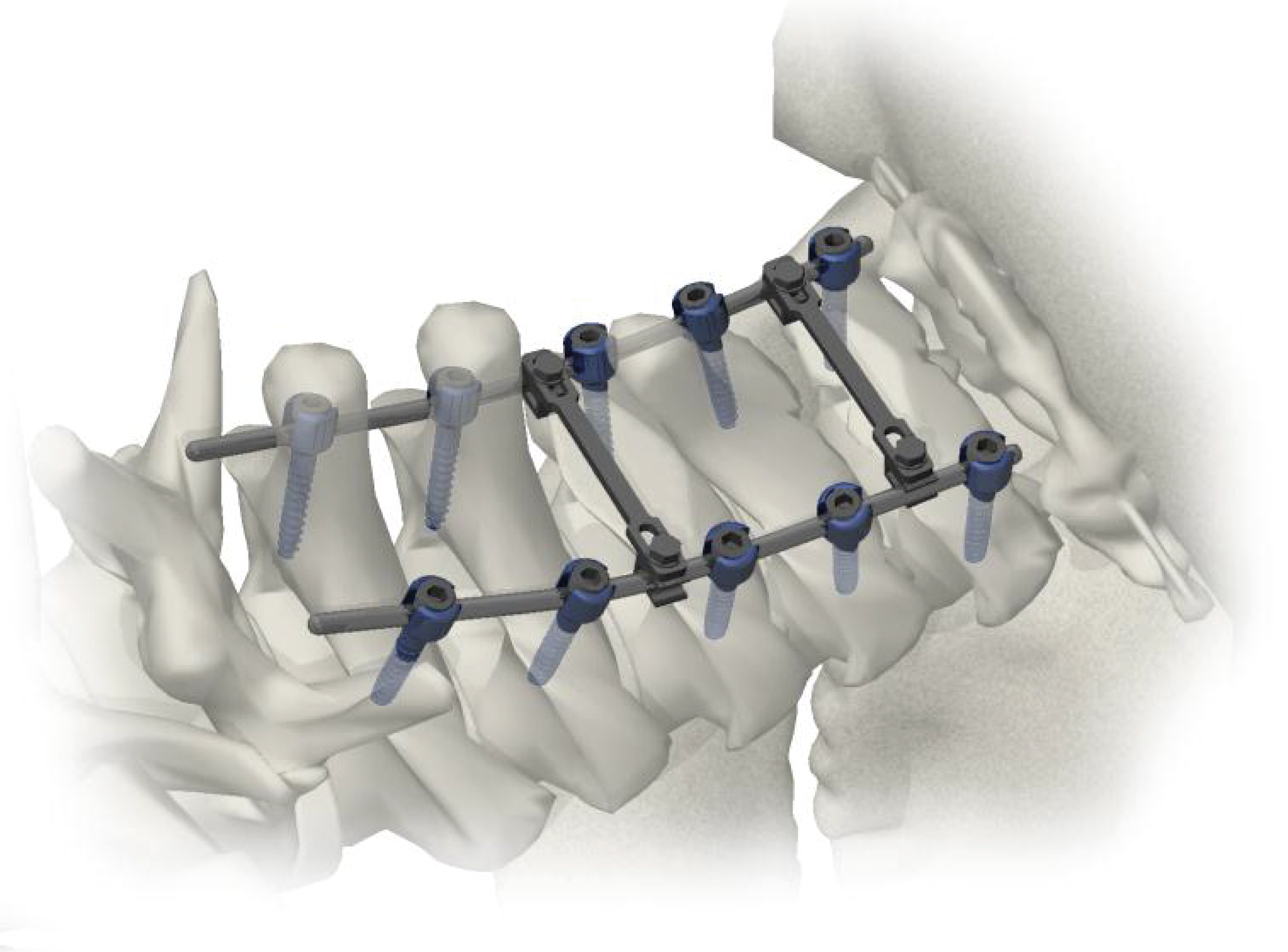 IMPLANTES TORNILLO MASSA LATERAL